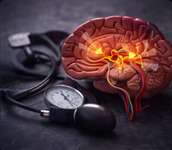 Idiopathic intracranial hypertension — brain pressure illustration
